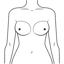 Silicone breast forms with realistic shape for transgender or post-op use